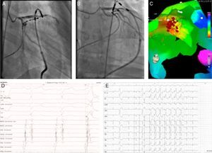 Epicardial ablation: catheter at the ablation site in right (A) and left (B) anterior oblique views. Activation map (C) showing earliest activation site in the anterior side of the left ventricular outflow tract next to the anterior interventricular vein (red dots). Electrogram and pacemapping with 12/12 lead match at the site of successful ablation (D and E).