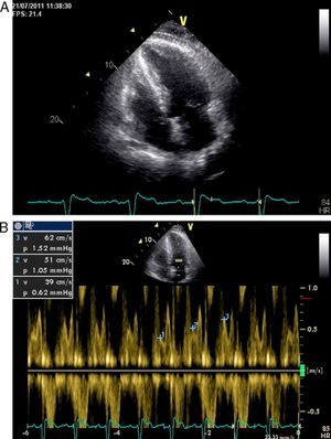 Transthoracic echocardiogram, showing (A) thickened and echogenic pericardium, and (B) respiratory variation of E-wave amplitude.