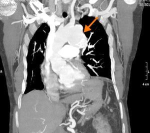 Thoracic computed tomography angiography, showing a large saccular aneurysm originating in the descending thoracic aorta, distal to the emergence of the left subclavian artery.