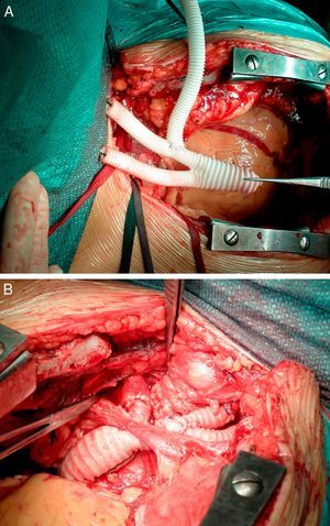 (A) Construction of three-branch graft; (B) total debranching of supra-aortic branches (left brachiocephalic, carotid and subclavian arteries).