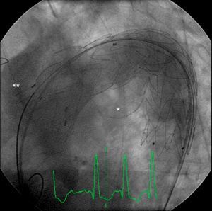 Aortography following endoprosthesis implantation, confirming exclusion of calcified aneurysm (asterisk) from the circulation and patency of the supra-aortic arteries after debranching.