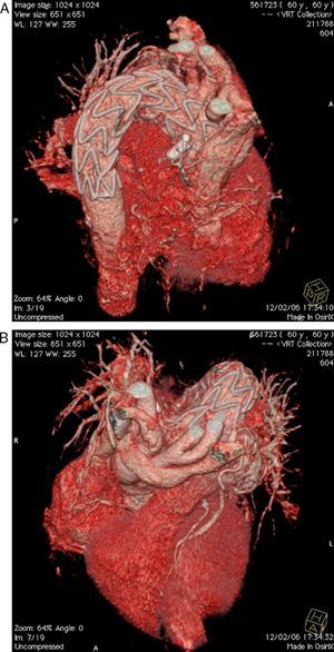 Thoracic computed tomography angiography, showing a good result of endoprosthesis implantation (A) and supra-aortic debranching (B).