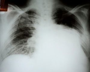 Chest X-ray showing opacity in the base and middle third of the left hemithorax, with calcified contours. An area of oligemia can be seen in the left upper third of the pulmonary parenchyma, with interstitial infiltrate on the right.
