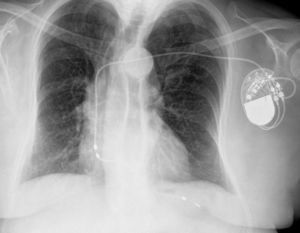 Posteroanterior chest X-ray, showing the pacemaker lead tip outside the heart, below the contour of the left hemidiaphragm.