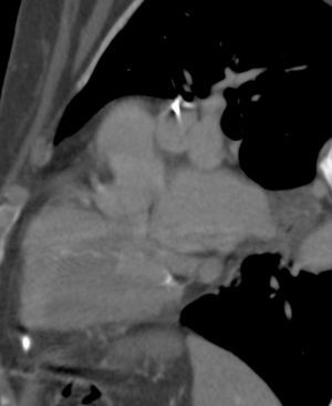 Multidetector computed tomography with multiplanar reconstruction in sagittal oblique view, showing the position of the lead tip outside the heart in the anterior mediastinum, above the diaphragm.