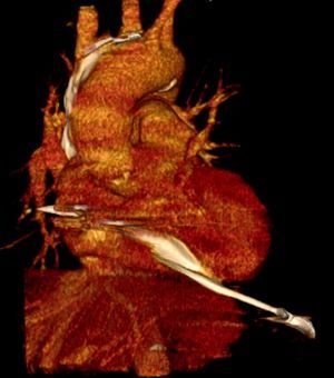 Multidetector computed tomography, three-dimensional reconstruction, clearly showing the lead tip outside the heart.