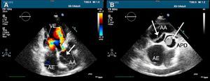 Transthoracic echocardiogram showing (A) moderate aortic regurgitation, dilated aortic root and intimal flap with image suggestive of a double lumen; (B) thrombus in the right pulmonary artery (arrow). AA: ascending aorta; AE: left atrium; APD: right pulmonary artery; VE: left ventricle.