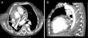 Thoracic computed tomography angiography with intravenous contrast: (A) transverse view showing an organized thrombus adhering to the wall of the right pulmonary artery (thin arrow) and filling of the true lumen of the aortic dissection (wide arrow); (B) sagittal view showing the dissection extending along the descending thoracic aorta (arrows).