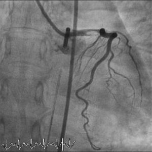 Coronary angiography showing an image suggestive of thrombus in the left main coronary artery (anteroposterior projection with caudal angulation).