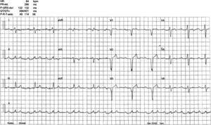 Baseline ECG: sinus rhythm, intraventricular conduction defects and significant PR prolongation.