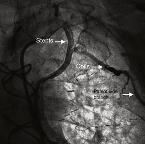 Angiogram after deployment of the coils in the side branch, still patent but with compromised flow, and two stents covering the dissected LIMA segment.