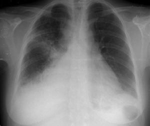 Chest X-ray at admission.