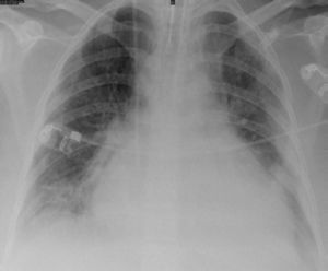 Chest X-ray on the 10th day.