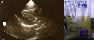 Transthoracic echocardiography prior to pericardiocentesis (A) and pericardial fluid of purulent appearance (B).