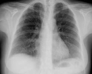 Chest X-ray at discharge.