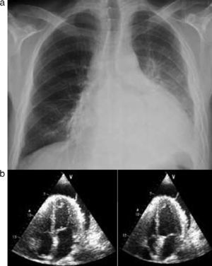 Chest X-ray (A) and transthoracic echocardiography (B) at admission.