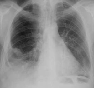 Chest X-ray at discharge.