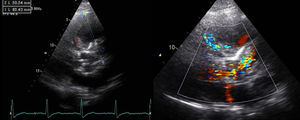 Transthoracic echocardiogram showing the Dacron tube graft in the ascending aorta (blue diamond) and a large aneurysm (53 mm × 71 mm) with thrombus (red diamond) and flow apparently originating from the proximal and distal ends of the tube.