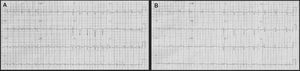 Electrocardiography at presentation with diffuse T-wave inversion (A) and after recurrent chest pain with transient ST-segment elevation in inferior leads (B).