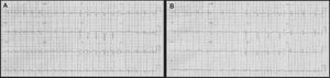 Electrocardiography at presentation with diffuse T-wave inversion (A) and after recurrent chest pain with transient ST-segment elevation in inferior leads (B).