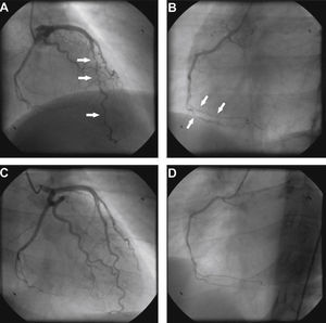 Coronary angiography at presentation showing diffuse vessel wall irregularities in the left anterior descending artery (A) and right coronary artery (B). Coronary angiography after one year of immunosuppressive therapy showing resolution of vasculopathy in the anterior descending artery (C) and right coronary artery (D).