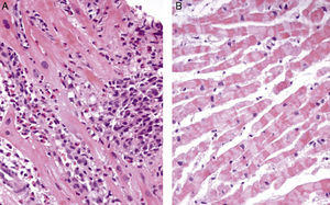 Hematoxylin and eosin cardiac biopsy specimen at presentation showing eosinophilic infiltration (A). Myocardial biopsy, after glucocorticoid and immunosuppressive therapy, showing complete resolution of eosinophilic myocarditis (B).