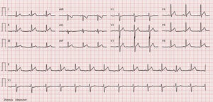 Electrocardiogram on day of chest pain onset: sinus rhythm and slight ST-segment elevation with upward concavity in leads I, II, III, aVF and V3–V6.