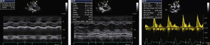 Echocardiographic findings at age 66. M-mode revealed a dilated left atrium (56 mm) (A), an enlarged left ventricular cavity (58.47 mm) with wall thickening (15.11 mm) and a small pericardial effusion (B). Doppler showed diastolic transmitral flow with an E/A-wave ratio of 2.39 and a deceleration time of 147 ms (C).