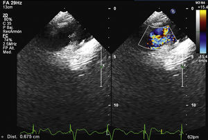 Echocardiogram in color Doppler view showing right pulmonary fistula with slow bidirectional flow.