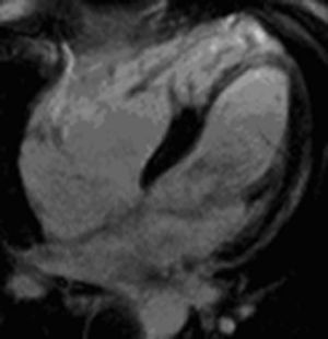 Late enhancement of the distal septum and right ventricular wall and right ventricular dilatation in 4-chamber view, phase-sensitive inversion recovery sequence, showing arrhythmogenic right ventricular dysplasia.