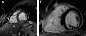 Pseudoaneurysms of the right ventricular free wall in short-axis view. (A) Steady-state free precession sequence; (B) phase-sensitive inversion recovery sequence. Late enhancement of the inferior septum and inferior wall of both ventricles, showing arrhythmogenic right ventricular dysplasia.