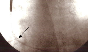 Fluoroscopy in posteroanterior view showing the externalized conductor (arrow) outside the shadow of the catheter in the region of the right atrium.