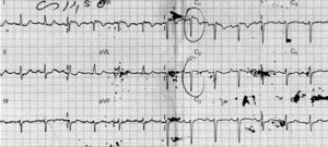 ECG on admission to the emergency department, showing 2-mm downsloping ST-segment elevation in V1 and V2 and symmetrical negative T waves – type 1 Brugada pattern.