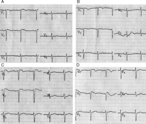 ECGs performed during the first flecainide test, with the patient medicated with lamotrigine: (A) leads V1 and V2 over the fourth intercostal space, before administration of flecainide; (B) leads V1 and V2 over the second intercostal space, before administration of flecainide; (C) leads V1 and V2 over the fourth intercostal space, after administration of flecainide; (D) leads V1 and V2 over the second intercostal space, after administration of flecainide, with 2-mm downsloping ST-segment elevation and negative T waves – type 1 Brugada pattern.