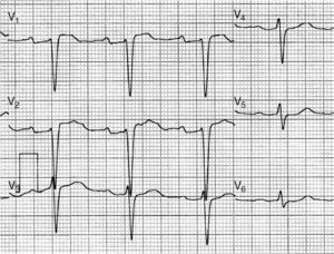 ECG performed during the second flecainide test following discontinuation of lamotrigine, with leads V1 and V2 over the second intercostal space after administration of flecainide – negative for type 1 Brugada pattern.