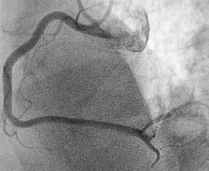 Right coronary artery after thrombus aspiration and balloon angioplasty.