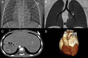 Mesocardia and situs inversus. (A) Topogram; (B) multiplanar reconstruction, coronal view; (C) axial image of the abdomen; (D) three-dimensional volume rendering showing mesocardia, morphological right bronchus in left position, morphological left bronchus in right position, liver on the left, stomach and spleen on the right, and anterior right aorta and posterior left pulmonary artery. Ao: aorta: B: spleen; E: stomach; F: liver; P: pulmonary artery.