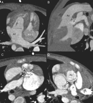 Atrioventricular and ventriculoarterial discordance with a single coronary artery. Axial (A) and multiplanar (B, C and D) reconstructions showing atrioventricular and ventriculoarterial discordance, with anterior right aorta and posterior left pulmonary artery, infundibular septal defect with subarterial communication (asterisk), and anomalous origin of the right coronary artery in the left coronary sinus, coursing between the aorta and the pulmonary artery. AD: right atrium; AE: left atrium; Ao: aorta; CD: right coronary artery; Cx: circumflex artery; DA: anterior descending artery; P: pulmonary artery; VD: right ventricle; VE: left ventricle.