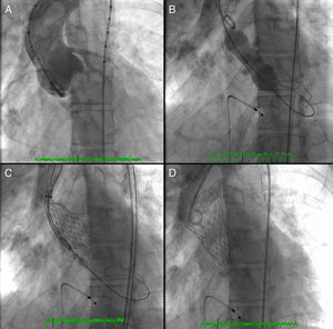 Fluoroscopic images during initial aortic angiography (A), balloon valvuloplasty under rapid pacing (B), release and expansion of CoreValve™ prosthesis (C), and fully expanded prosthesis (D).