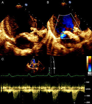 Transthoracic echocardiogram showing the correctly positioned aortic prosthesis (A), with a small central regurgitant jet (B), and peak transvalvular gradient of 17 mmHg (C).