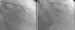 A thin, long, eccentric and calcified critical lesion in the mid circumflex coronary artery (A); guidewire-induced type III coronary rupture demonstrating significant contrast streaming into the pericardium (B).