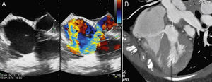 (A) Transesophageal echocardiography with and without color Doppler revealing subaortic flow to the right atrium; (B) cardiac computed tomography confirming the presence of a subaortic fistula (arrow).