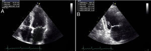 Measurement of left atrial volume by the biplane method of disks (modified Simpson's rule) in apical 4-chamber (A) and apical 2-chamber (B) view in end-systole (maximum left atrial size).