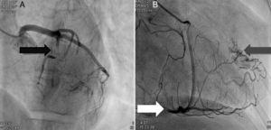 Coronary angiography showing (A) bridging at various points along the left coronary artery (black arrow: anterior descending) and (B) several right and left coronary artery-left ventricular fistulae (gray arrow). A recanalized thrombus can be seen in the posterolateral branch (white arrow).
