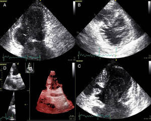 Transthoracic echocardiography showing (A) basal posteroinferior aneurysm (two-dimensional apical 2-chamber view); (B) endomyocardial trabeculations and recesses communicating with the ventricular cavity (two-dimensional parasternal short-axis view); (C and D) two intramyocardial recesses in the basal portion of the inferoseptal wall communicating with the left ventricular cavity, around 4 mm in diameter, the larger one traversing almost the entire thickness of the wall but with no interventricular communication (two- and three-dimensional images, respectively, apical 4-chamber view).