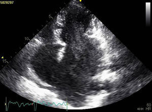 Transthoracic echocardiography showing severely dilated left atrium with spontaneous contrast in the left chambers (two-dimensional apical 4-chamber view).