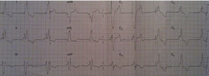 Electrocardiogram at first heart failure consultation.