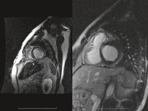 Left: the inferolateral wall with a transmural infarct with obvious wall thinning, while the left ventricular cavity shows a gray signal due to contrast admixed with blood. Right: a patient with acute myocarditis with subepicardial lateral wall enhancement.