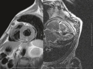 The panel on the left is a T1-weighted image with wall thickening. Beside is the LGE image showing global subendocardial enhancement with no cavitary signal. Both ventricles are involved.