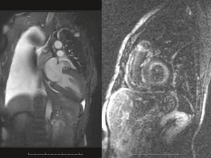 A patient with decompensated congestive heart failure as evidenced by massive pleural effusion (left) had very good LV systolic function with concentric hypertrophy, while the LGE sequence (right) was diagnostic for amyloidosis.